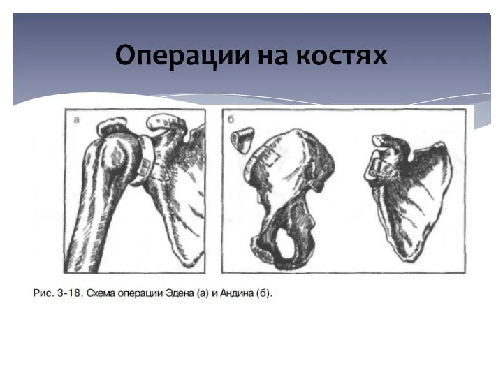 Операции на костях