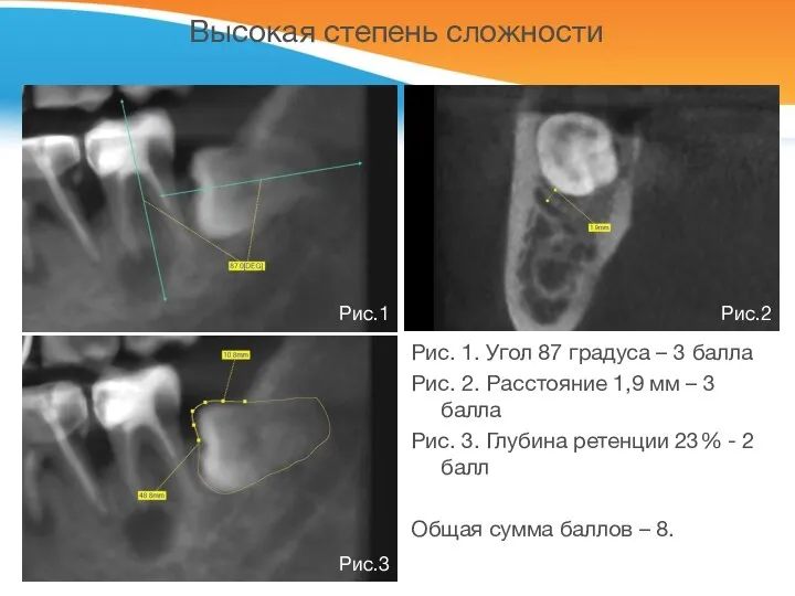 Высокая степень сложности Рис. 1. Угол 87 градуса – 3 балла Рис.