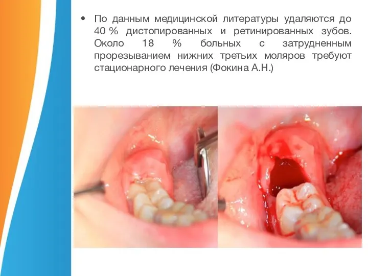 По данным медицинской литературы удаляются до 40 % дистопированных и ретинированных зубов.