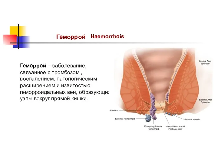 Геморрой Haemorrhois Геморрой – заболевание, связанное с тромбозом , воспалением, патологическим расширением