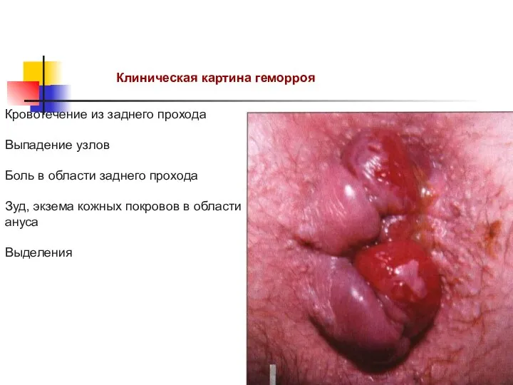 Клиническая картина геморроя Кровотечение из заднего прохода Выпадение узлов Боль в области