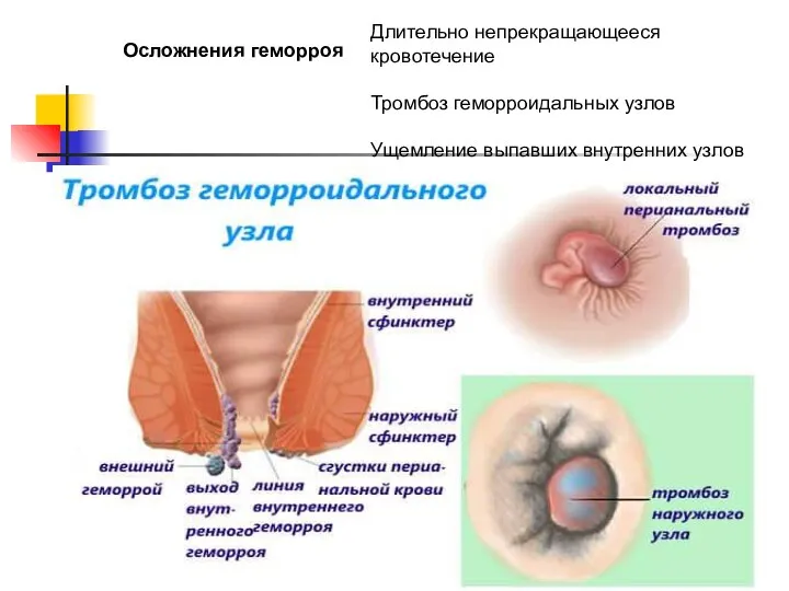 Осложнения геморроя Длительно непрекращающееся кровотечение Тромбоз геморроидальных узлов Ущемление выпавших внутренних узлов