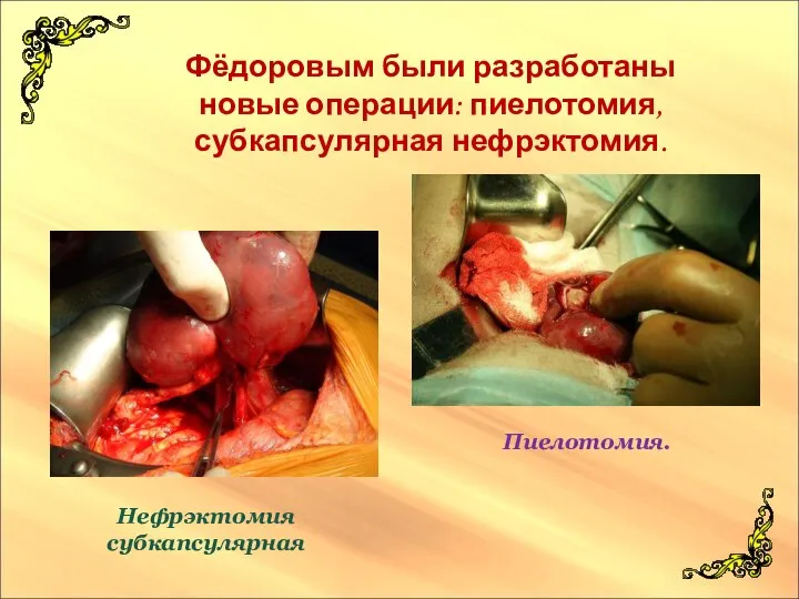 Фёдоровым были разработаны новые операции: пиелотомия, субкапсулярная нефрэктомия. Нефрэктомия субкапсулярная Пиелотомия.