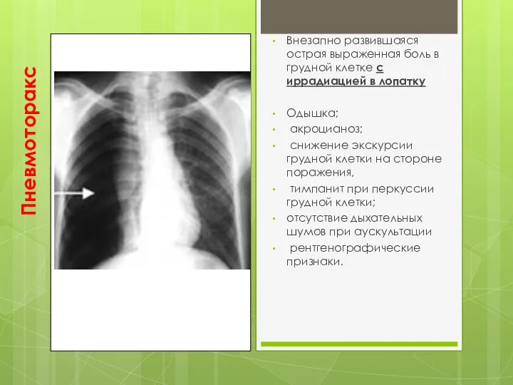 Пневмоторакс Внезапно развившаяся острая выраженная боль в грудной клетке с иррадиацией в