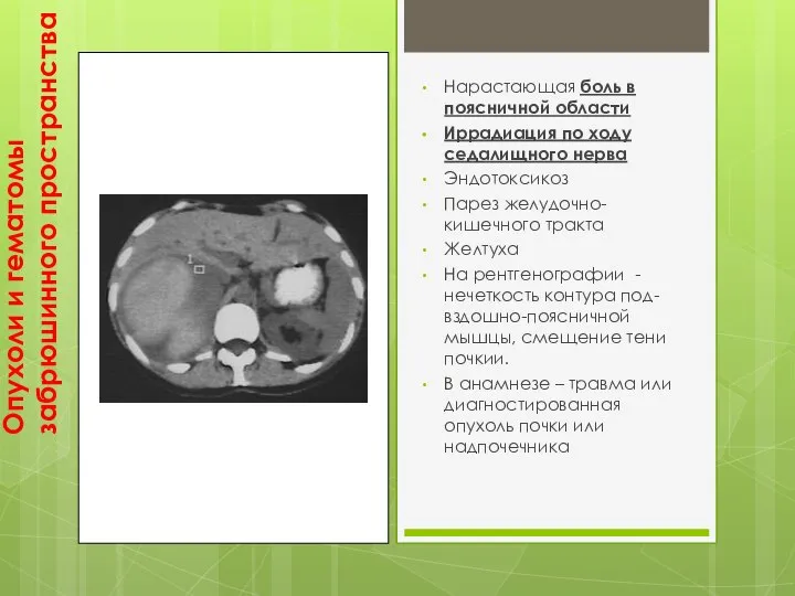 Опухоли и гематомы забрюшинного пространства Нарастающая боль в поясничной области Иррадиация по