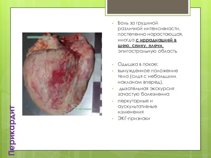 Перикардит Боль за грудиной различной интенсивности, постепенно нарастающая, иногда с иррадиацией в