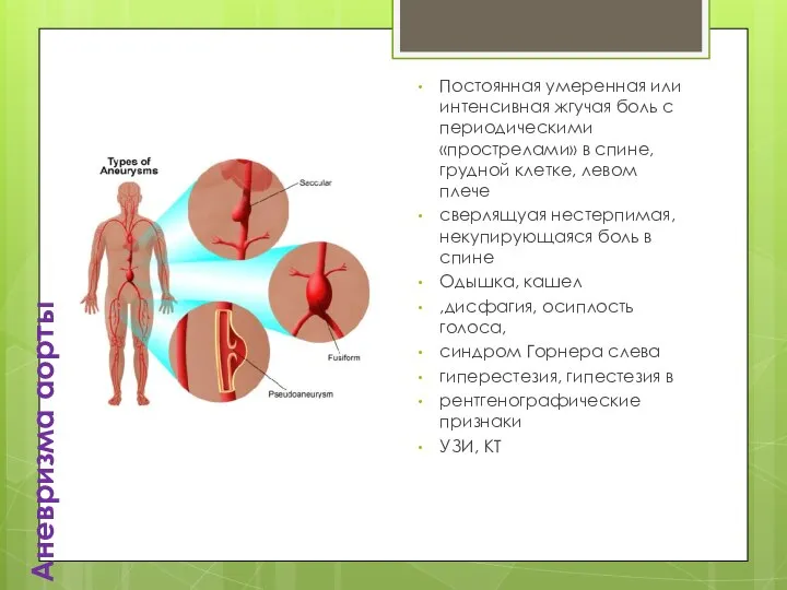 Аневризма аорты Постоянная умеренная или интенсивная жгучая боль с периодическими «прострелами» в