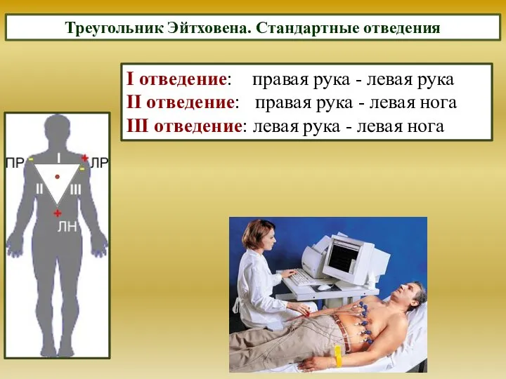 Треугольник Эйтховена. Стандартные отведения I отведение: правая рука - левая рука II