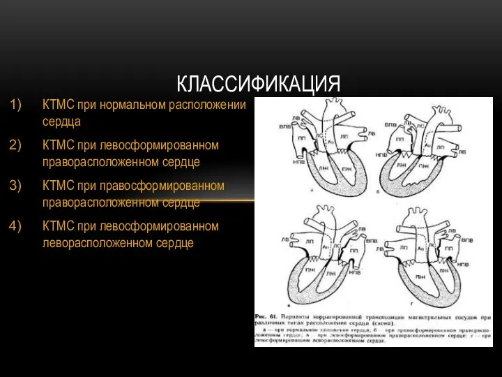 КТМС при нормальном расположении сердца КТМС при левосформированном праворасположенном сердце КТМС при