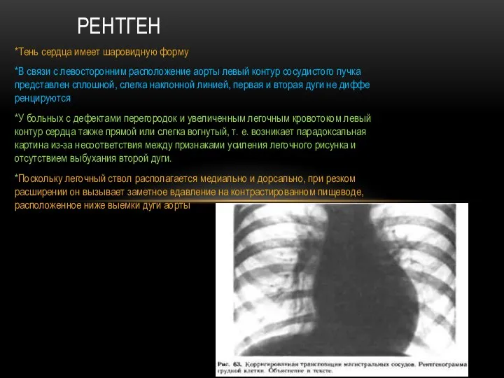 *Тень сердца имеет шаровидную форму *В связи с левосторонним расположе­ние аорты левый