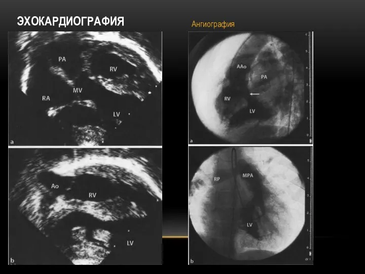 ЭХОКАРДИОГРАФИЯ Ангиография