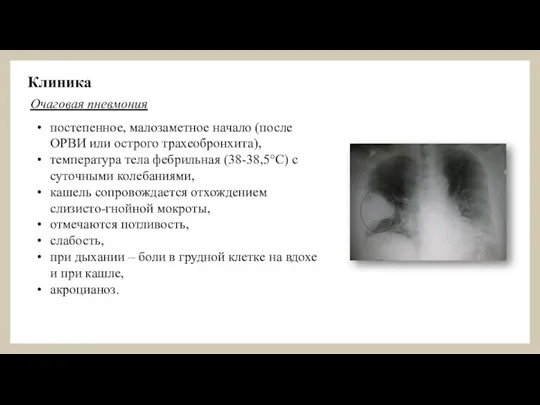 Клиника постепенное, малозаметное начало (после ОРВИ или острого трахеобронхита), температура тела фебрильная