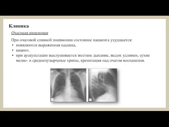 При очаговой сливной пневмонии состояние пациента ухудшается: появляются выраженная одышка, цианоз. при