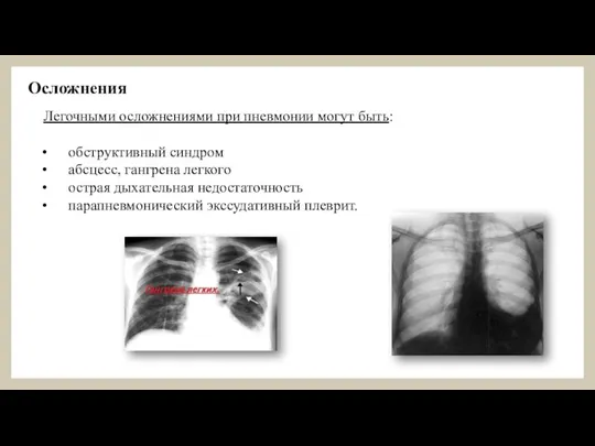 Осложнения Легочными осложнениями при пневмонии могут быть: обструктивный синдром абсцесс, гангрена легкого