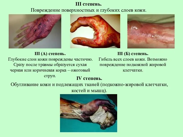 III степень. Повреждение поверхностных и глубоких слоев кожи. III (А) степень. Глубокие