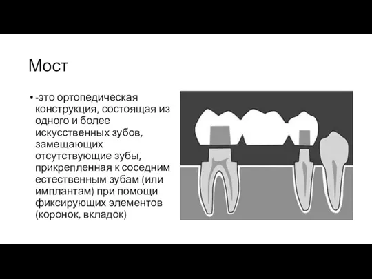 Мост -это ортопедическая конструкция, состоящая из одного и более искусственных зубов, замещающих