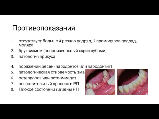 Противопоказания отсутствует больше 4 резцов подряд, 2 премоляров подряд, 1 моляра бруксизмом