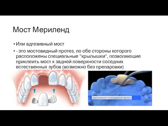 Мост Мериленд Или адгезивный мост - это мостовидный протез, по обе стороны