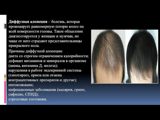 Диффузная алопеция – болезнь, которая провоцирует равномерную потерю волос на всей поверхности