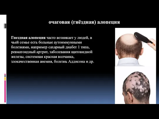 очаговая (гнёздная) алопеция Гнездная алопеция часто возникает у людей, в чьей семье