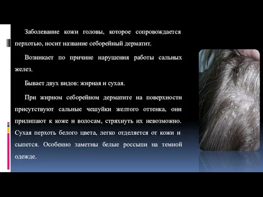 Заболевание кожи головы, которое сопровождается перхотью, носит название себорейный дерматит. Возникает по