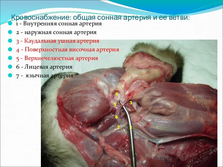 Кровоснабжение: общая сонная артерия и ее ветви: 1 - Внутренняя сонная артерия