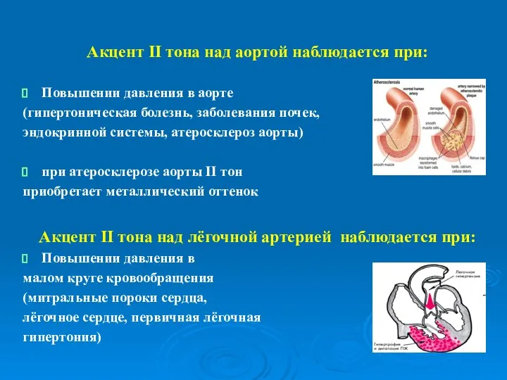 Акцент II тона над аортой наблюдается при: Повышении давления в аорте (гипертоническая