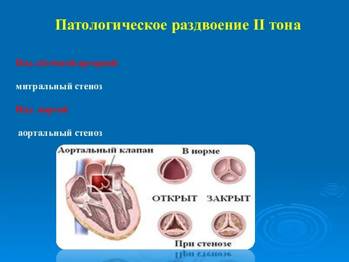 Патологическое раздвоение II тона Над лёгочной артерией митральный стеноз Над аортой аортальный стеноз