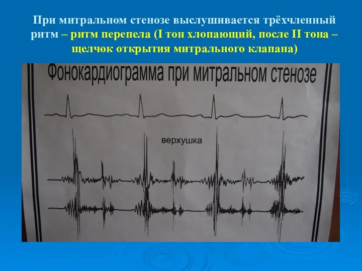 При митральном стенозе выслушивается трёхчленный ритм – ритм перепела (I тон хлопающий,