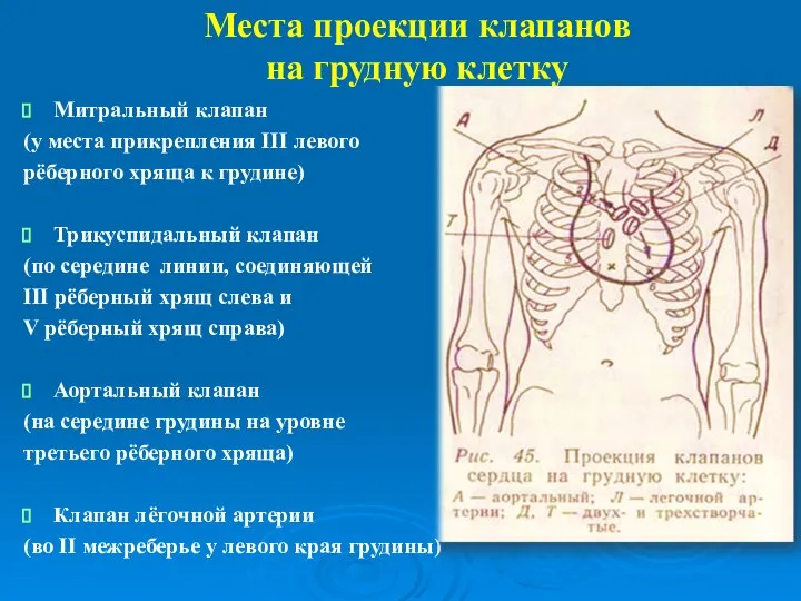 Места проекции клапанов на грудную клетку Митральный клапан (у места прикрепления III