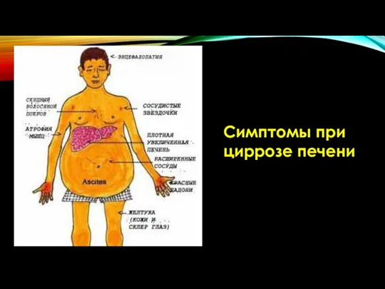 Симптомы при циррозе печени