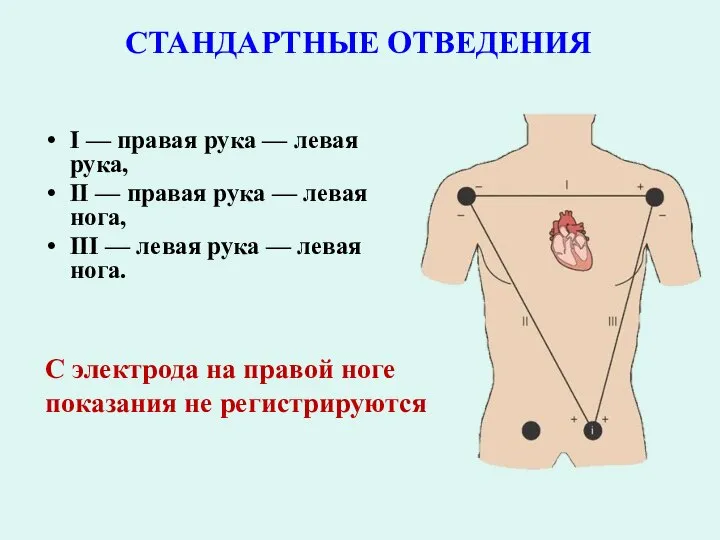 СТАНДАРТНЫЕ ОТВЕДЕНИЯ I — правая рука — левая рука, II — правая