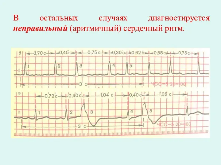 В остальных случаях диагностируется неправильный (аритмичный) сердечный ритм.