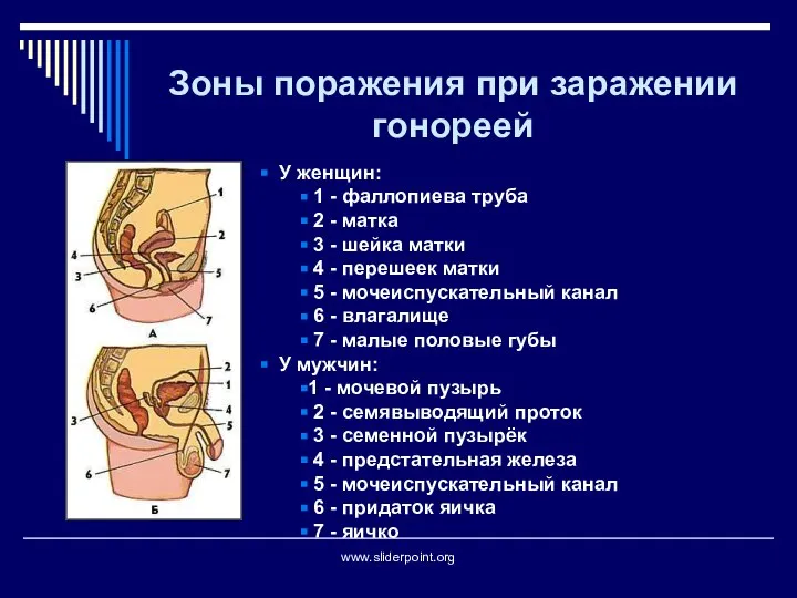 Зоны поражения при заражении гонореей У женщин: 1 - фаллопиева труба 2
