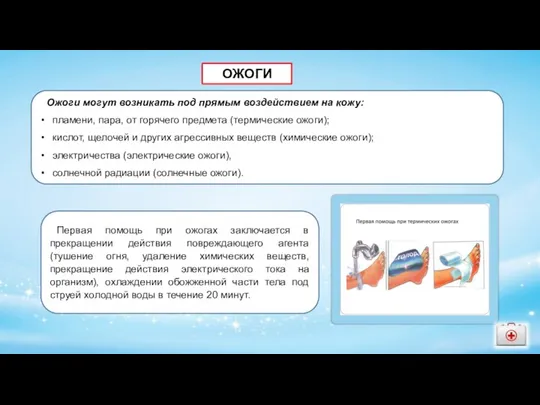 ОЖОГИ Ожоги могут возникать под прямым воздействием на кожу: пламени, пара, от