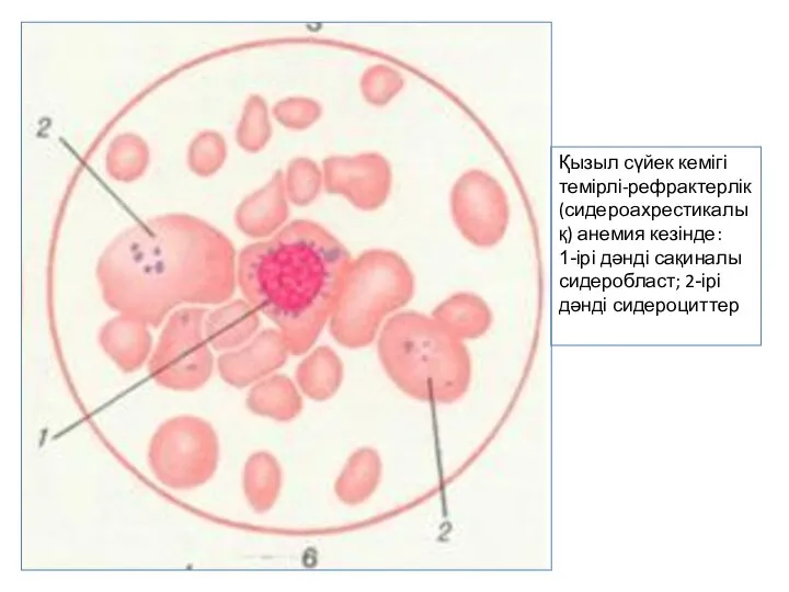 Қызыл сүйек кемігі темірлі-рефрактерлік (сидероахрестикалық) анемия кезінде: 1-ірі дәнді сақиналы сидеробласт; 2-ірі дәнді сидероциттер