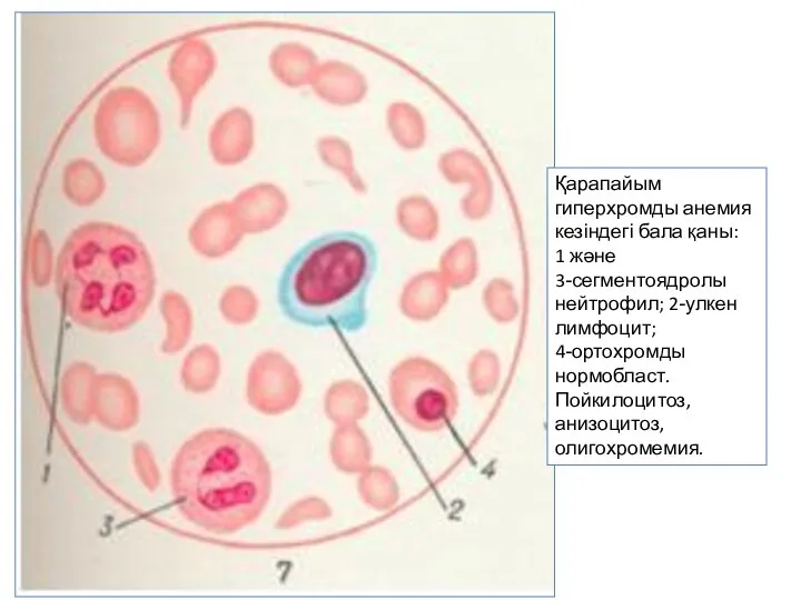 Қарапайым гиперхромды анемия кезіндегі бала қаны: 1 және 3-сегментоядролы нейтрофил; 2-улкен лимфоцит;