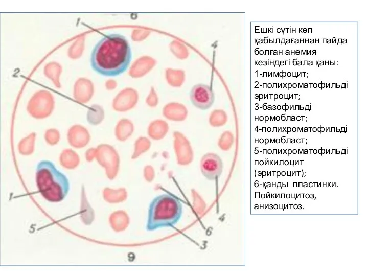 Ешкі сүтін көп қабылдағаннан пайда болған анемия кезіндегі бала қаны: 1-лимфоцит; 2-полихроматофильді