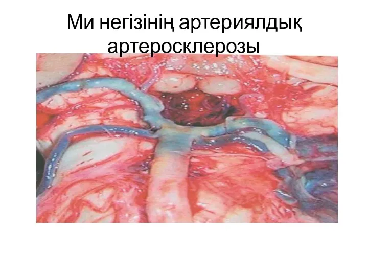 Ми негізінің артериялдық артеросклерозы