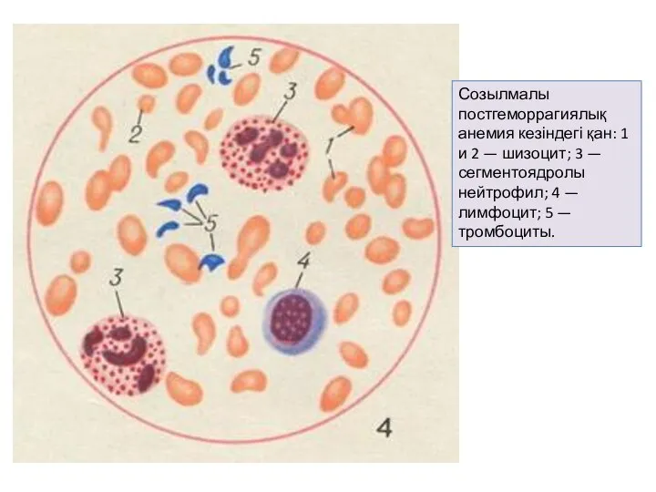 Созылмалы постгеморрагиялық анемия кезіндегі қан: 1 и 2 — шизоцит; 3 —