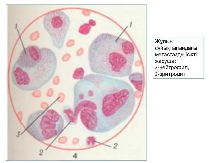 Жұлын сұйықтығындағы метастазды ісікті жасуша; 2-нейтрофил; 3-эритроцит.