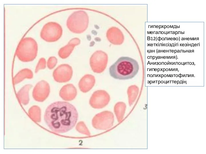 гиперхромды мегалоцитарлы В12(фолиево) анемия жеткіліксіздігі кезіндегі қан (анентеральная спруанемия). Анизопойкилоцитоз, гиперхромия, полихроматофилия. эритроциттердің