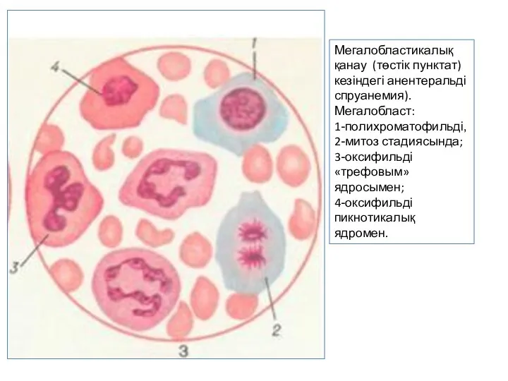 Мегалобластикалық қанау (төстік пунктат) кезіндегі анентеральді спруанемия). Мегалобласт: 1-полихроматофильді, 2-митоз стадиясында; 3-оксифильді