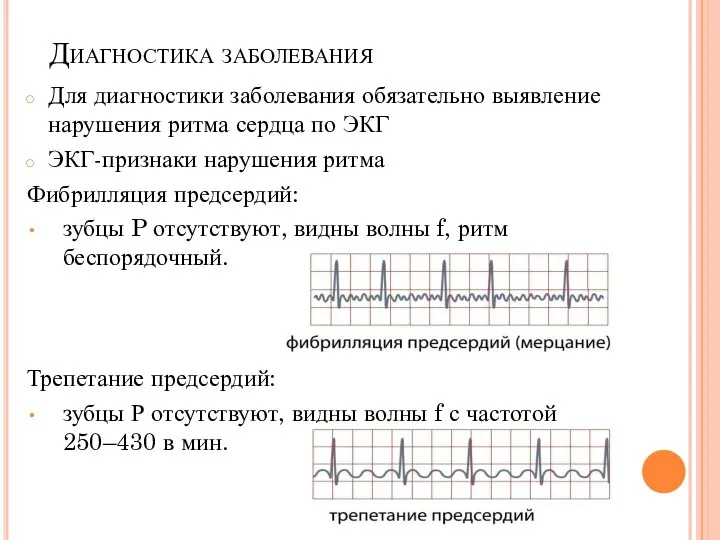 Диагностика заболевания Для диагностики заболевания обязательно выявление нарушения ритма сердца по ЭКГ