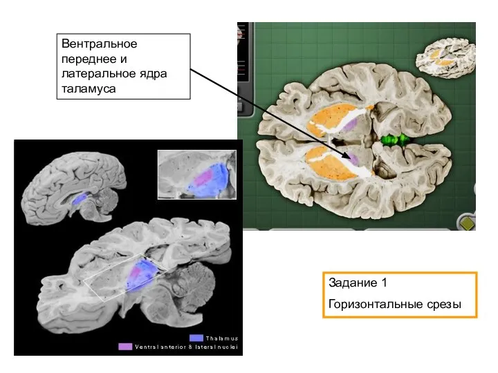 Вентральное переднее и латеральное ядра таламуса Задание 1 Горизонтальные срезы