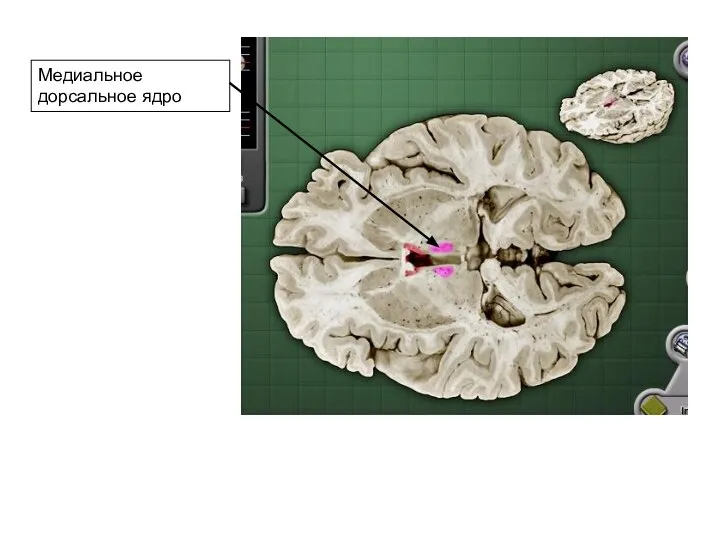 Медиальное дорсальное ядро