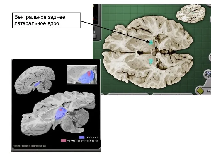 Вентральное заднее латеральное ядро