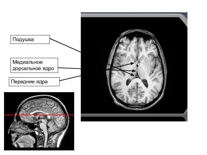 Подушка Медиальное дорсальное ядро Передние ядра