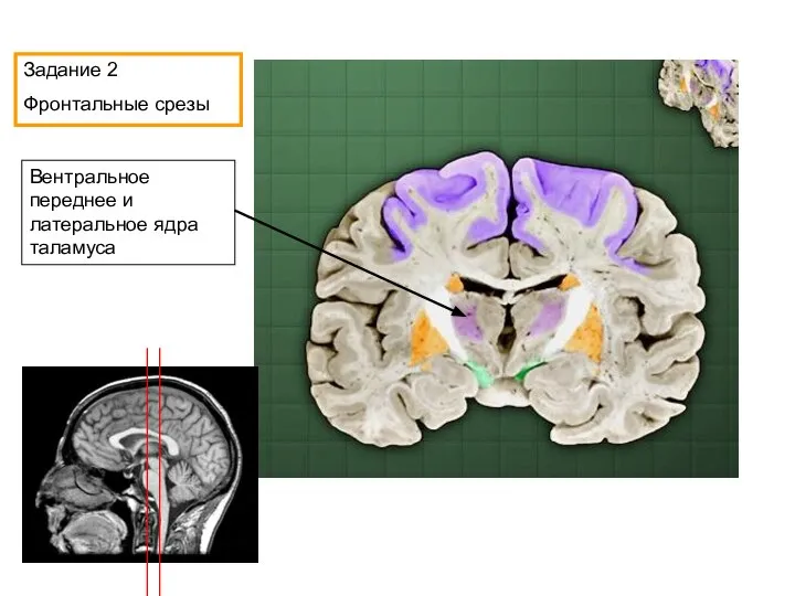 Вентральное переднее и латеральное ядра таламуса Задание 2 Фронтальные срезы