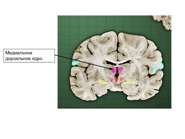 Медиальное дорсальное ядро